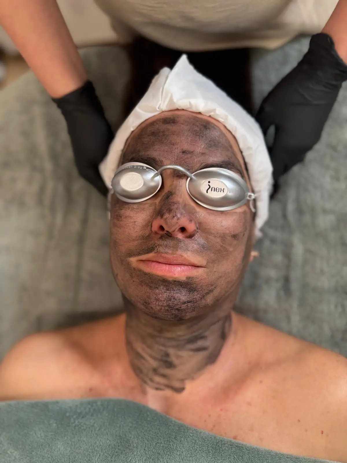 Resultado Pure Glow | Carbon Peel - 4