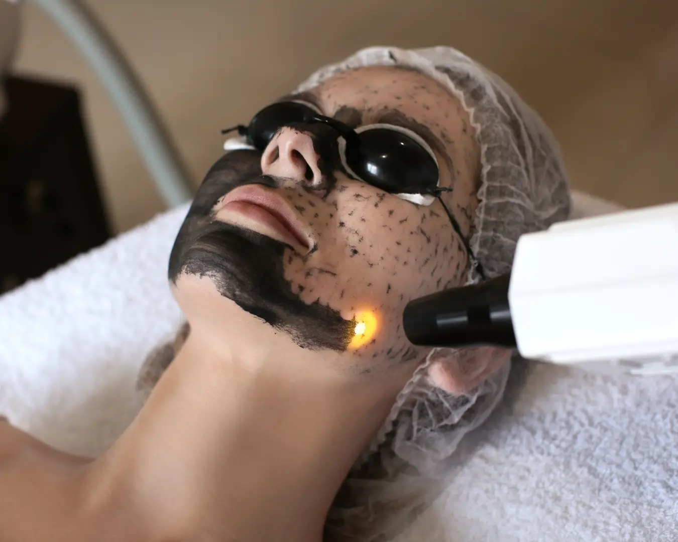 Resultado Pure Glow | Carbon Peel - 3
