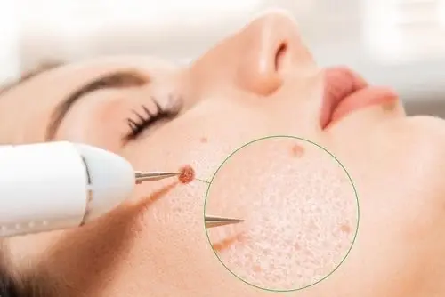 Resultado FibroClean | Resección de Fibromas - 1