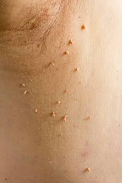 Resultado FibroClean | Resección de Fibromas - 2