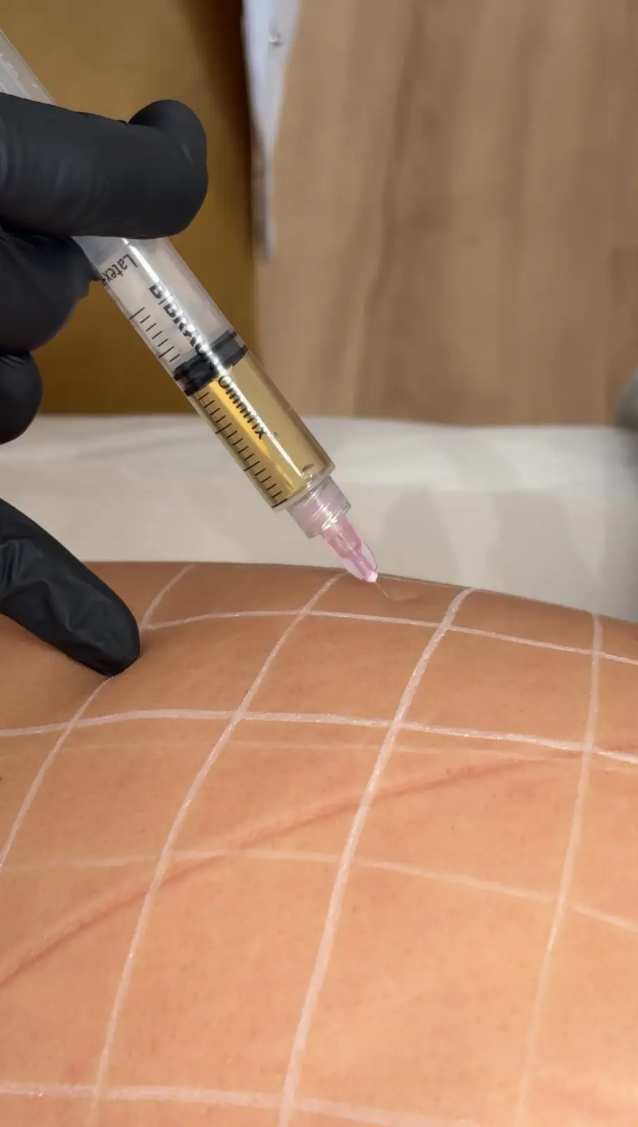 Tratamiento médico-estético en Ikonic Clinic Palma 27
